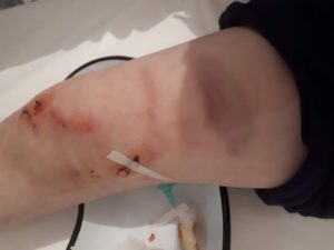 Gyerekre támadt a medve Homoródremetén